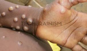 More Than 80 Cases of Monkeypox Confirmed in 12 Countries